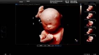 Samsung WS80a Ultrasound with HD Demo