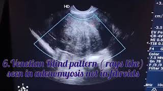 Ultrasound features of adenomyosis amd its difference with fibroids@vivekanandahospitalofficial