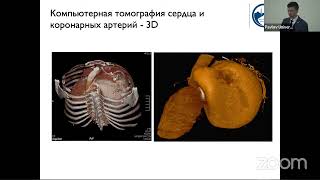 Возможности методов визуализации в диагностике и определении тактики лечения атриомегалии