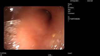 Stenosis of previous Gastrojejunostomy anastomoses site on endoscopy