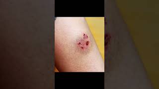 AFTER DOG BITE WHAT WE SHOULD DO FIRST #education #medical #ytshorts #medicine #medicalstudent