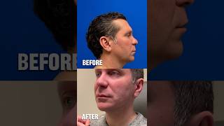 Chin Implant and Jawline Augmentation #shorts