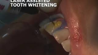 [Việt Can Nha Khoa]_Laser Assisted Teeth Whitening