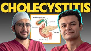 Ep 14: Acalculous vs Calculus Cholecystitis: Everything You Need To Know