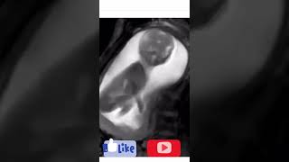 #MRI  scan| showing baby playing in the Uterus |