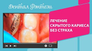 🦷 Лечение скрытого кариеса без страха. Процесс лечения кариеса 2 зубов