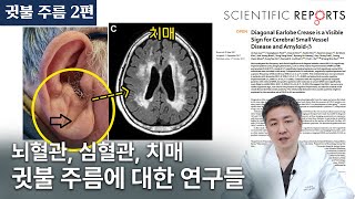 귓불 주름 2편: "귓불 주름이 정말 치매와 관련이 있나요?" 뇌질환, 심장질환, 치매, 이마 주름 등 귓불 주름에 대한 연구들