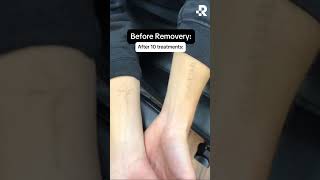 Before & After Tattoo Removal at Removery ✨