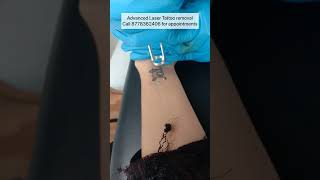 Safest place in Chennai for Tattoo Laser removal #shorts #reels #chennai #lasertattooremoval #laser