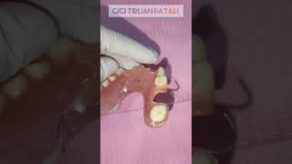 WDC_REMOVABLE  DENTURE | GIGI TIRUAN PATAH #shorts  #dentist dentist