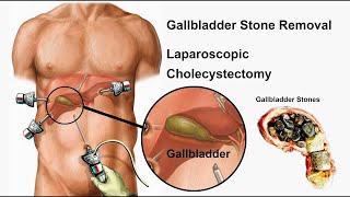 दूरबीन द्वारा पित्त की थैली कैसे निकालते है  #Laparoscopic #Cholecystectomy | #Gallbladder Surgery