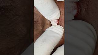 Satisfying cyst removal @designerdoc #shorts #satisfyingvideo #skintreatment