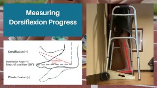 Measuring Dorsiflexion Progress for Tibia Lengtheners