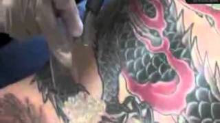 Laser Tattoo Removal, Tatoo Removal, Remove Tattoos, Philad