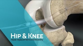 ACL Reconstruction: The All-Inside Technique | ACL Surgery