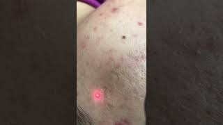 Laser beaching treatment | laser toning treatment | लेज़र ब्लीच चेहरेके लिए