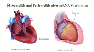 Myocarditis/pericarditis after mRNA vaccination