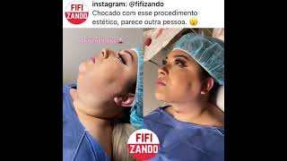 redução de papada faz suseso no   Instagram