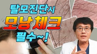 탈모진단 과정에서 모낭을 체크해야하는 이유