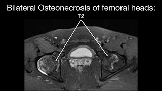 Bilateral Osteonecrosis (Avascular Necrosis) of Both Femoral Heads