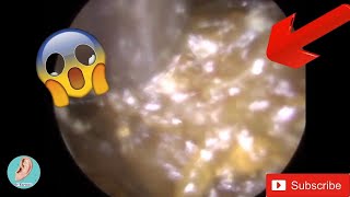 Ear Wax Removal  Suction revealing MIDDLE EAR EFFUSION #1