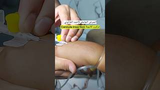 تعليم تركيب كانيولا Cannula insertion