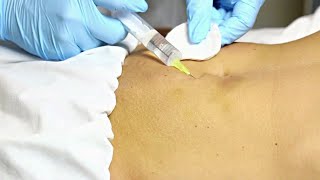 Anticellulite Injections (Needles) on Abdomen #navel