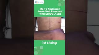 Men's Abdomen Laser Hair Removal #doctor #short #hairremoval #treatment