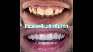 تجميل اسنان عدسات الايماكس emax#السعودية#emax حالة رقم 3