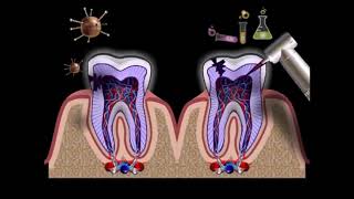 Что такре пульпит  Воспаление зуба  Как лечить пульпит  Стоматология