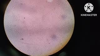 Urine slide ...hematuria (presence in Rbc under the microscope 40x absorbe.....