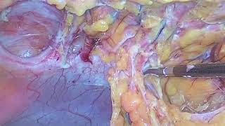 LIVE laparoscopic ventral hernia repair/Ventral yirtiga gore Laparoskopik hernia plastikasi