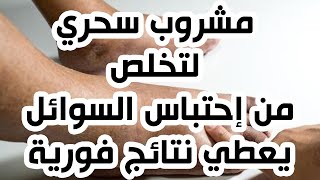 أسباب وطرق التخلص من احتباس الماء بالجسم