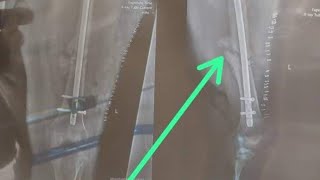 🔴Live Tibia Fibula Femur & Other Fracture's ||  Question & Answer