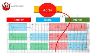 ECG localisation of the occluded coronary artery (Myocardial Infarction)