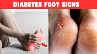 10 Signs Your Feet Tell You About Diabetes