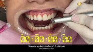 Veneer removal with LiteTouch™ Er:YAG laser