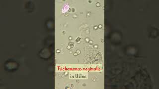 trichomonas vaginalis in urine #shorts