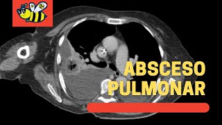 Absceso pulmonar (caso radiológico directo a la miel)