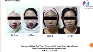 0811 1721 280, Membuat Tumbuh Rambut di Kalibata City Rinanda  Skin Care Center