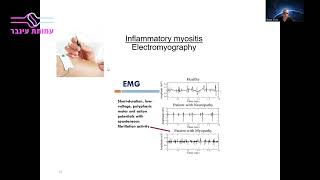 מחלות אוטואימוניות של השריר - פרופ' שי קיויתי, מרכז רפואי מאיר