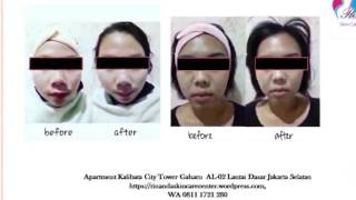 0811 1721 280, Cara Perut Kurus di Kalibata City Rinanda  Skin Care Center