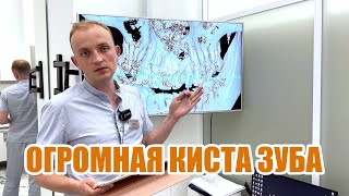 Удаление огромной с кисты зуба. Состояние через 3 года + полное видео всей операции