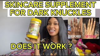 GET RID OF DARK KNUCKLES | my honest review on ladies shine skincare supplement