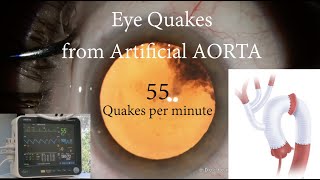 Eye Shaking 55 times per Minute from Artificial Aorta