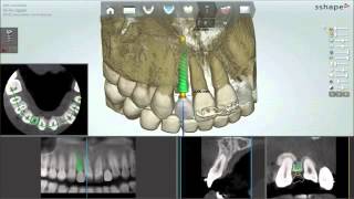 3Shape Guided Surgery Module