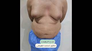 breast and tummy liposuction in Egypt