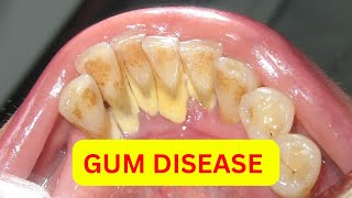 GUM *DISEASE* Explained Under 60 Seconds! (2024)