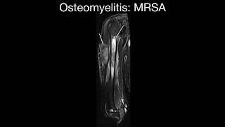 Osteomyelitis: MRSA