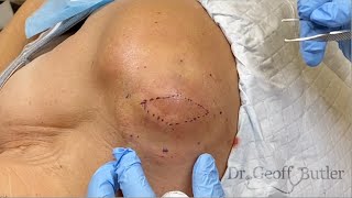 Removal of a firm lipoma on the left upper arm